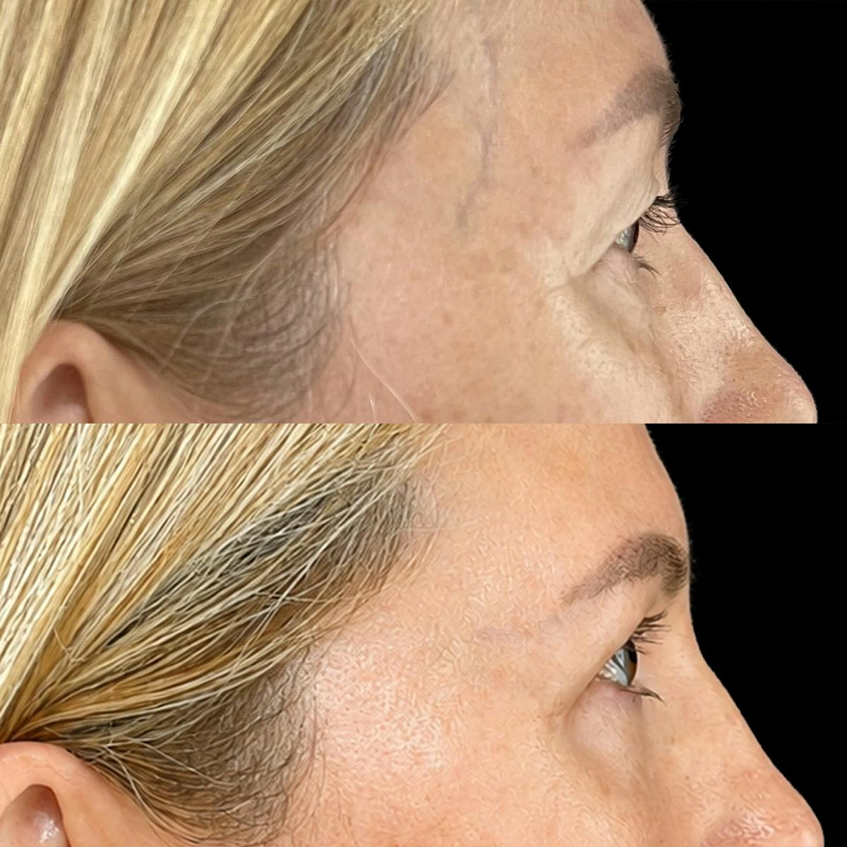 Eyelid Surgery Before & After Gallery - Patient 139637 - Image 2