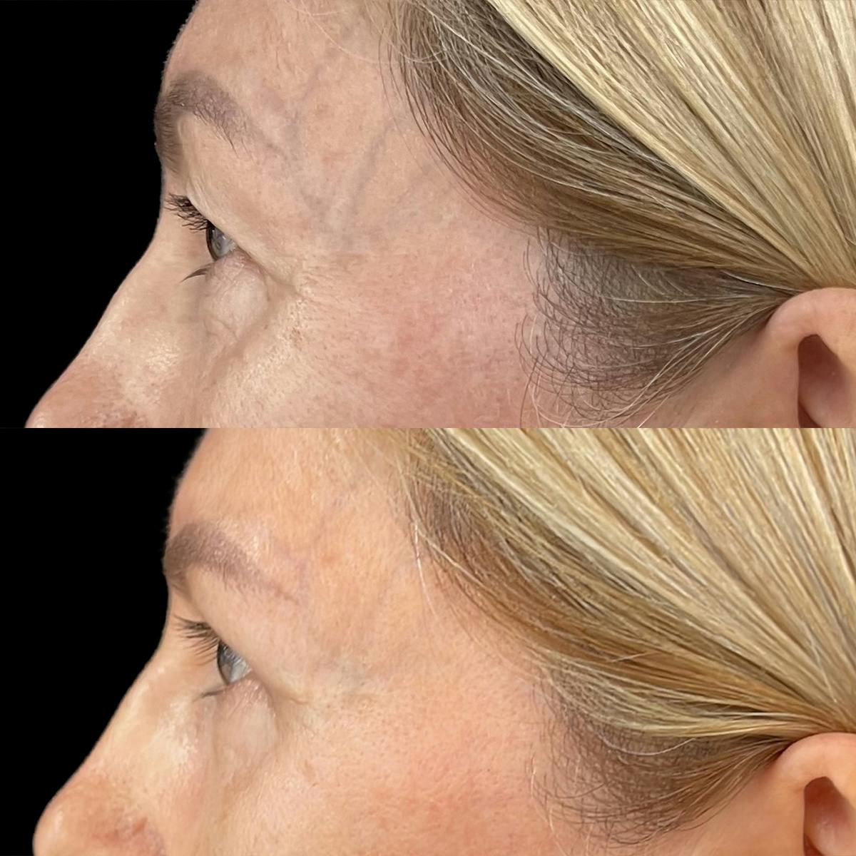 Eyelid Surgery Before & After Gallery - Patient 139637 - Image 3