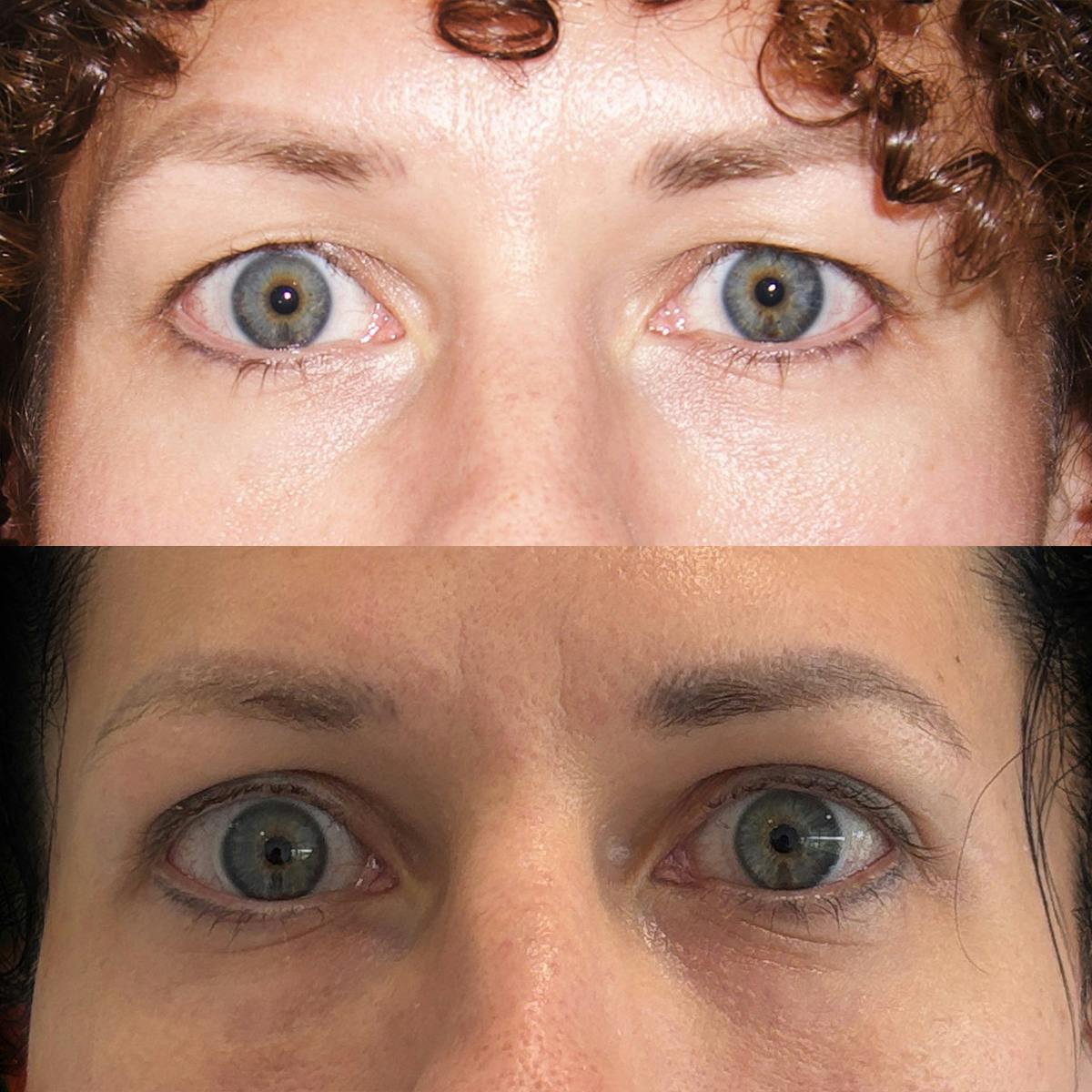 Eyelid Surgery Before & After Gallery - Patient 242590 - Image 1