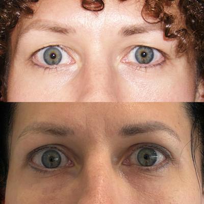 Eyelid Surgery Before & After Gallery - Patient 242590 - Image 1