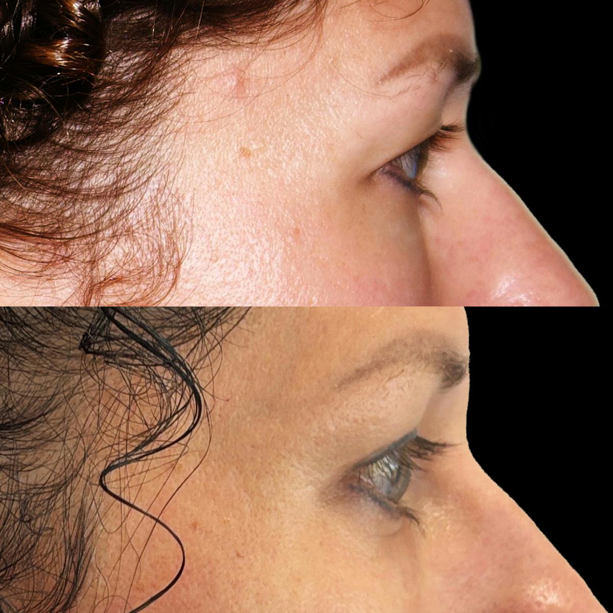 Eyelid Surgery Before & After Gallery - Patient 242590 - Image 2