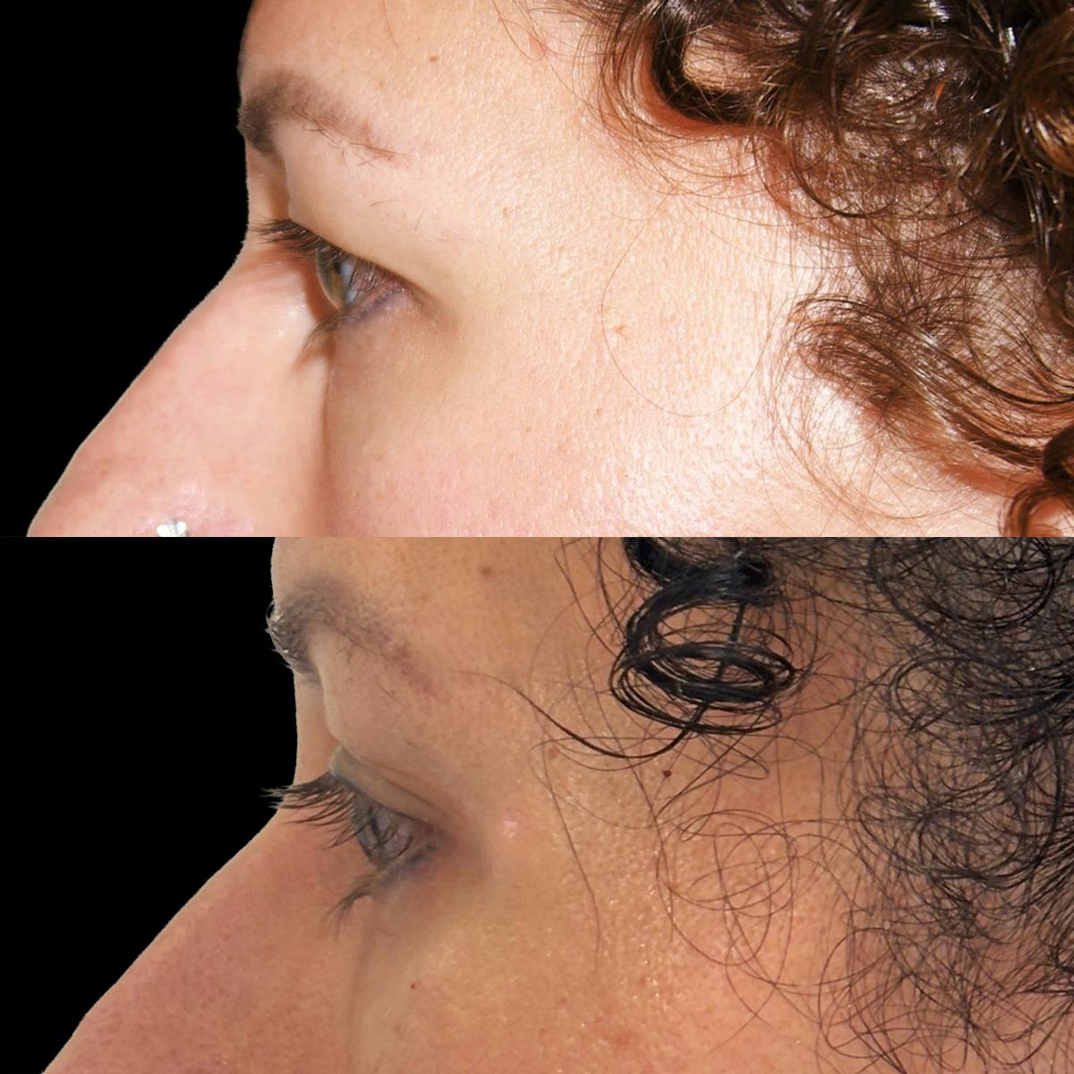 Eyelid Surgery Before & After Gallery - Patient 242590 - Image 3