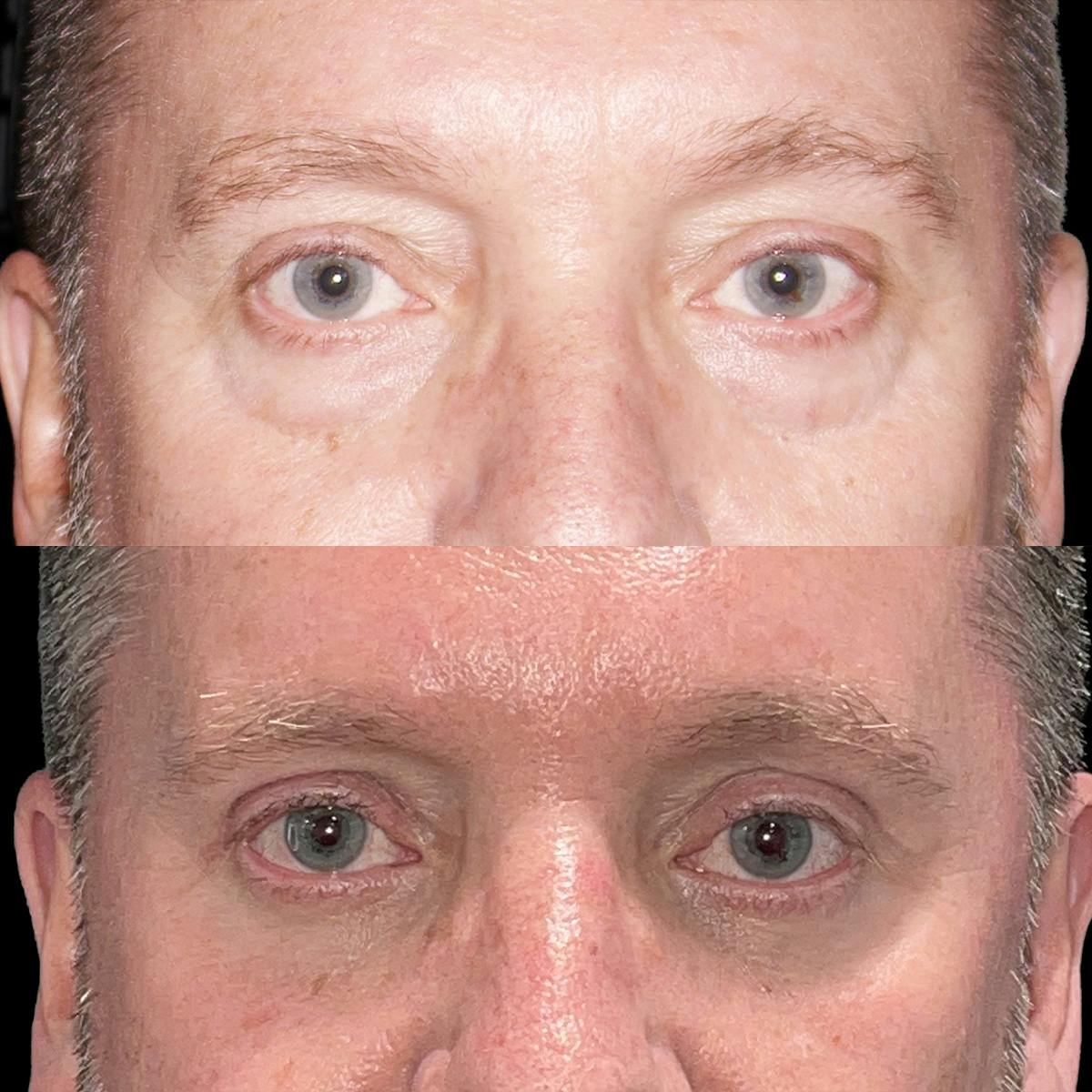 Eyelid Surgery Before & After Gallery - Patient 882377 - Image 1
