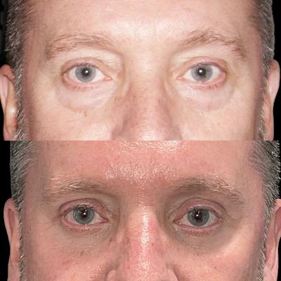 Eyelid Surgery Before & After Gallery - Patient 882377 - Image 1
