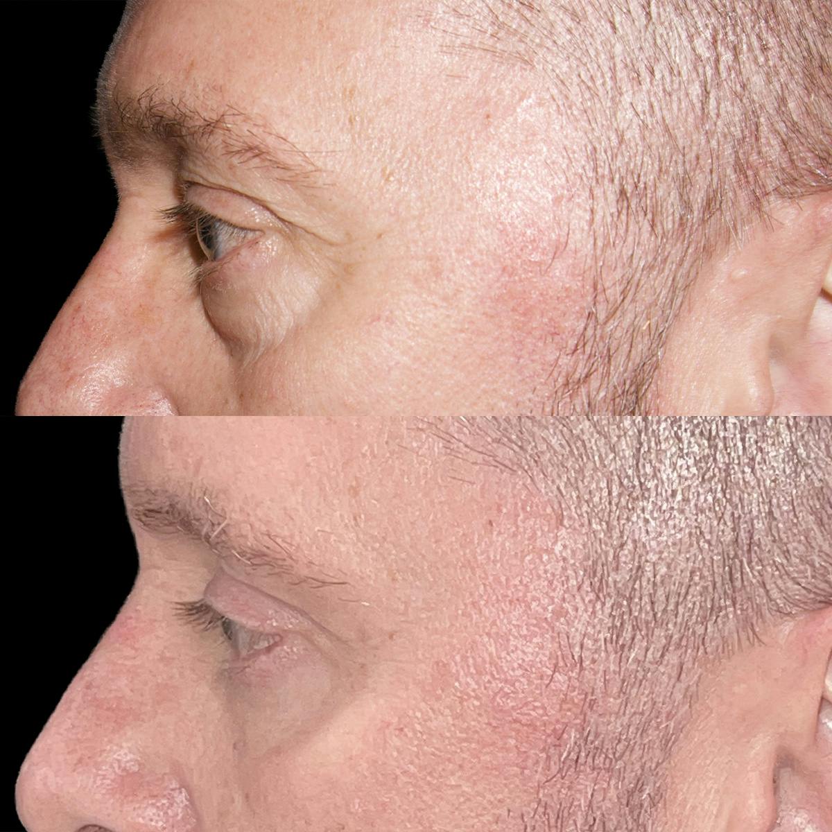 Eyelid Surgery Before & After Gallery - Patient 882377 - Image 3