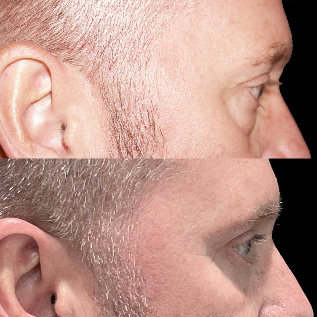 Eyelid Surgery Before & After Gallery - Patient 882377 - Image 2