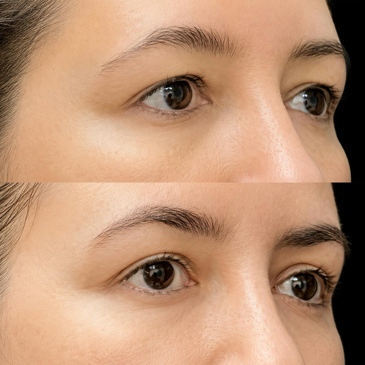 Eyelid Surgery Before & After Gallery - Patient 366146 - Image 2