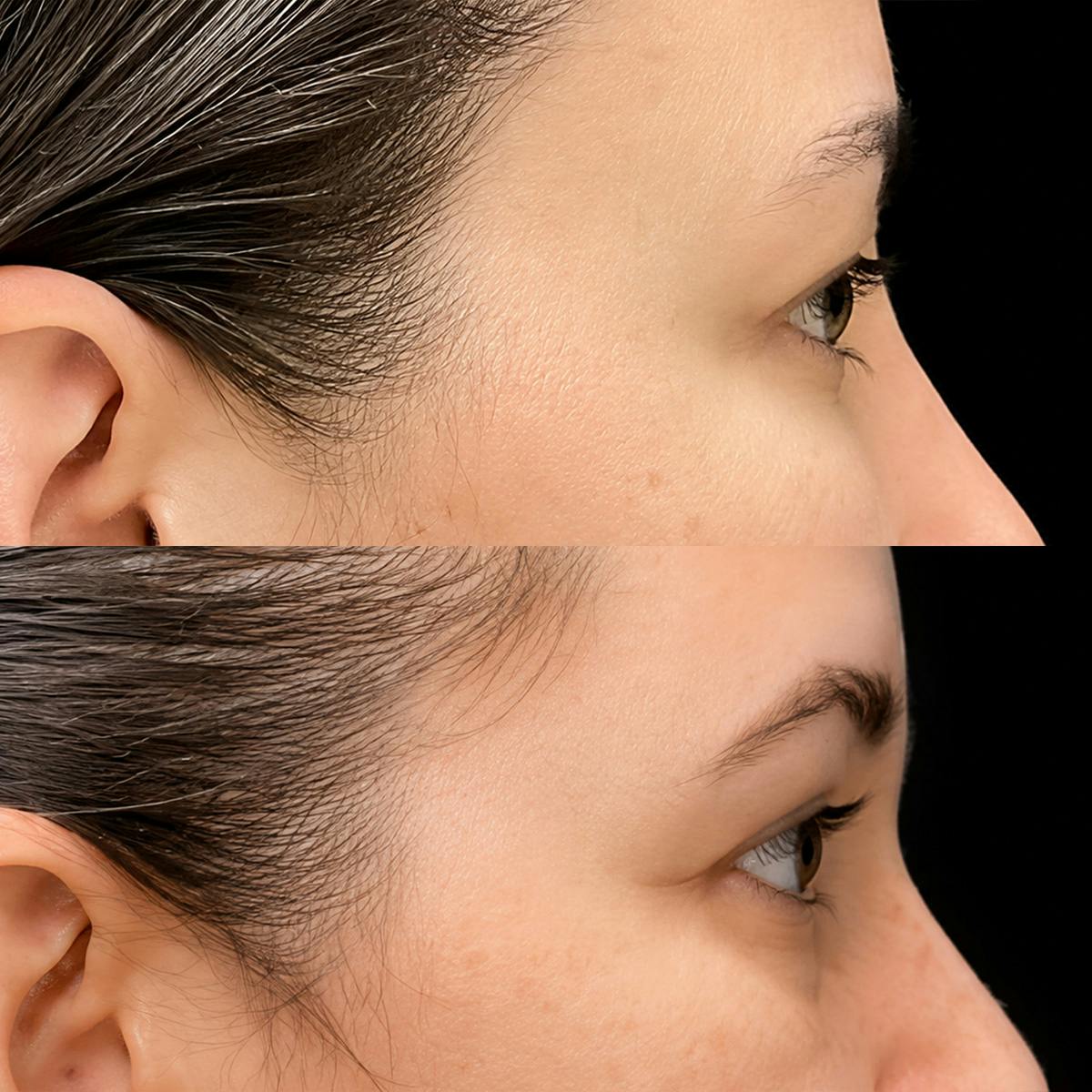 Eyelid Surgery Before & After Gallery - Patient 366146 - Image 3