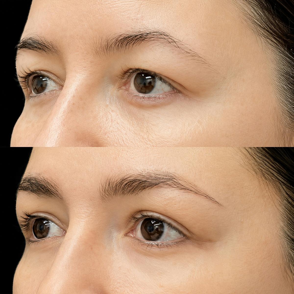 Eyelid Surgery Before & After Gallery - Patient 366146 - Image 4