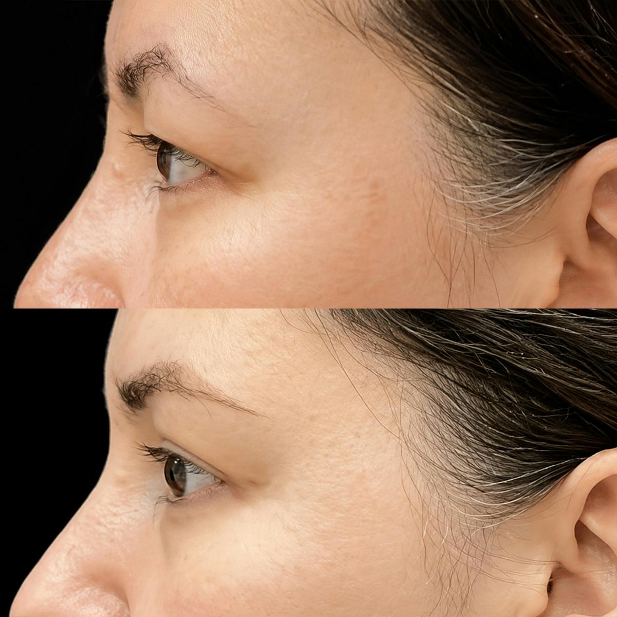 Eyelid Surgery Before & After Gallery - Patient 366146 - Image 5