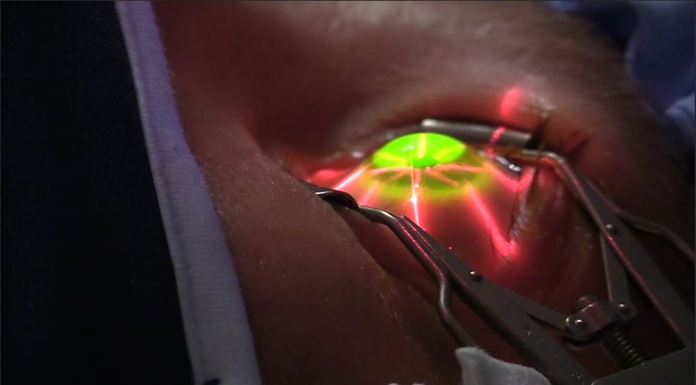Close up of an eye while lying down green light on the cornea