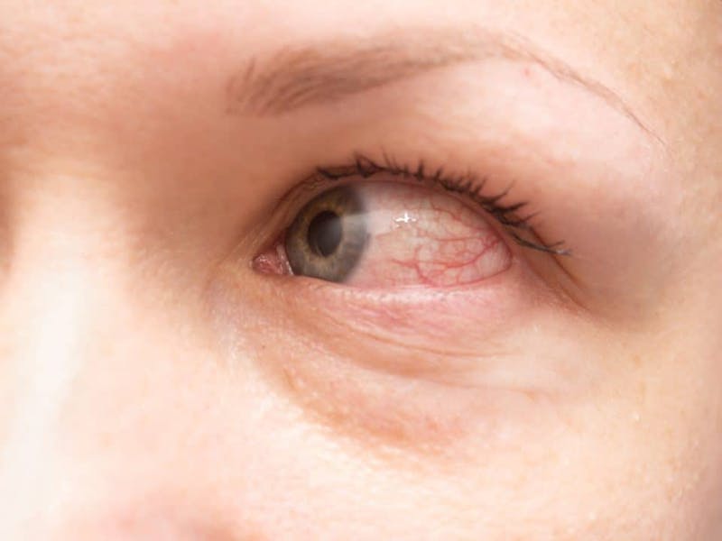 close up of a woman's red irritated eye