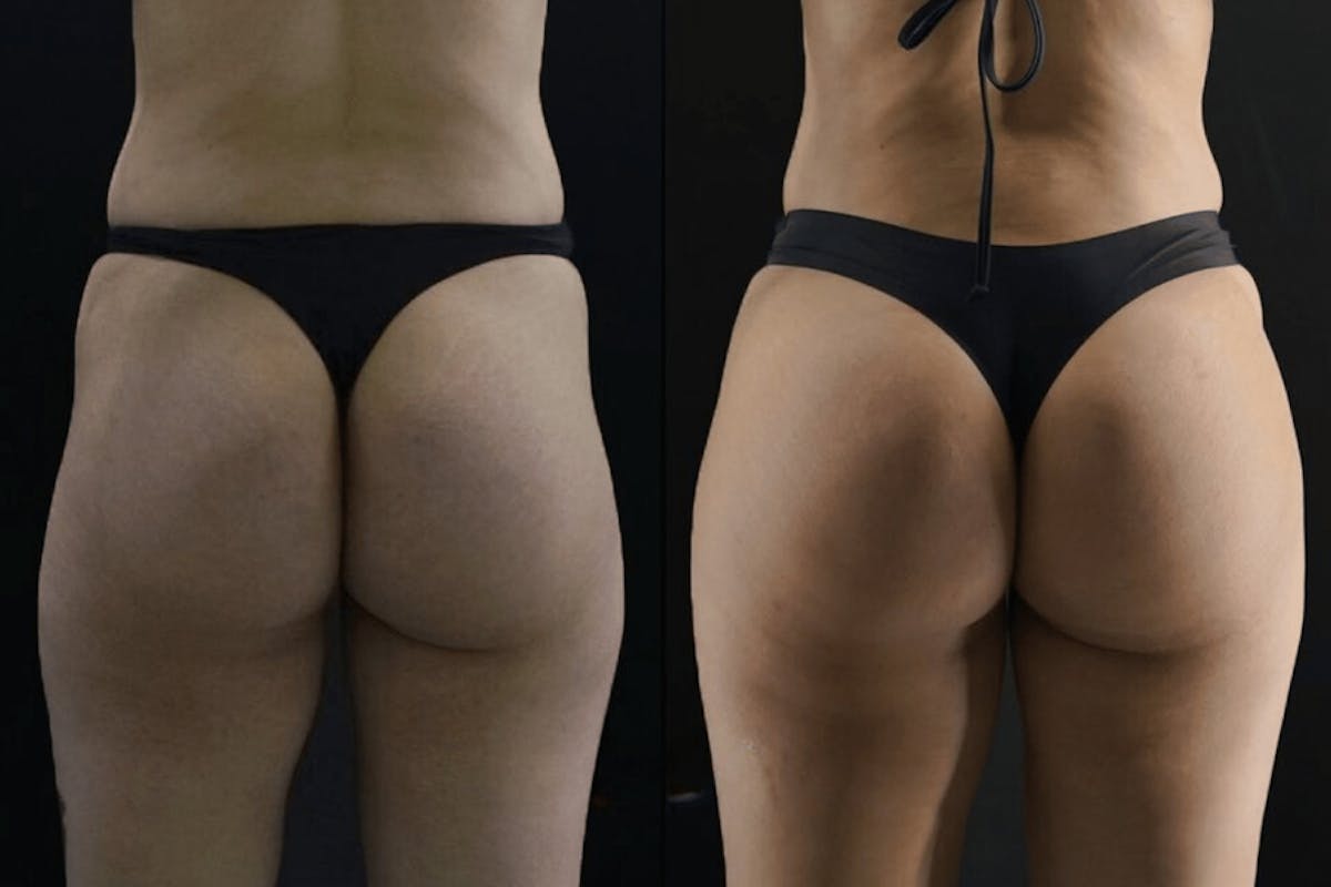 Brazilian Butt Lift Before & After Gallery - Patient 407740 - Image 2