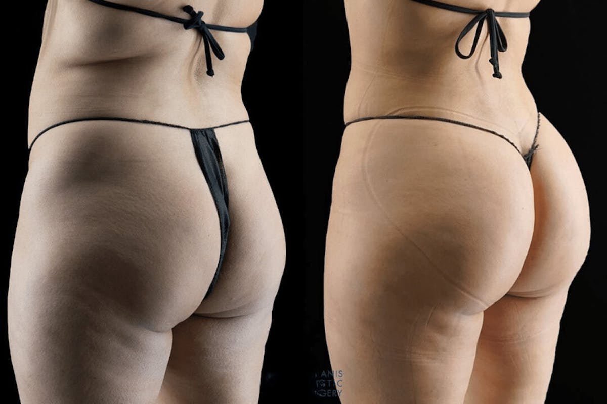 Brazilian Butt Lift Before & After Gallery - Patient 407740 - Image 1