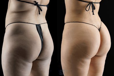 Brazilian Butt Lift Before & After Gallery - Patient 407740 - Image 1