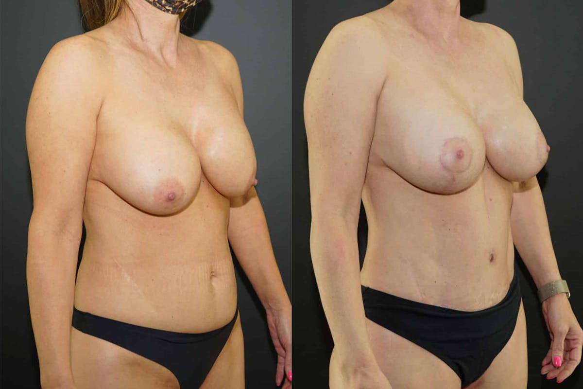 Mommy Makeover Before & After Gallery - Patient 318672 - Image 1