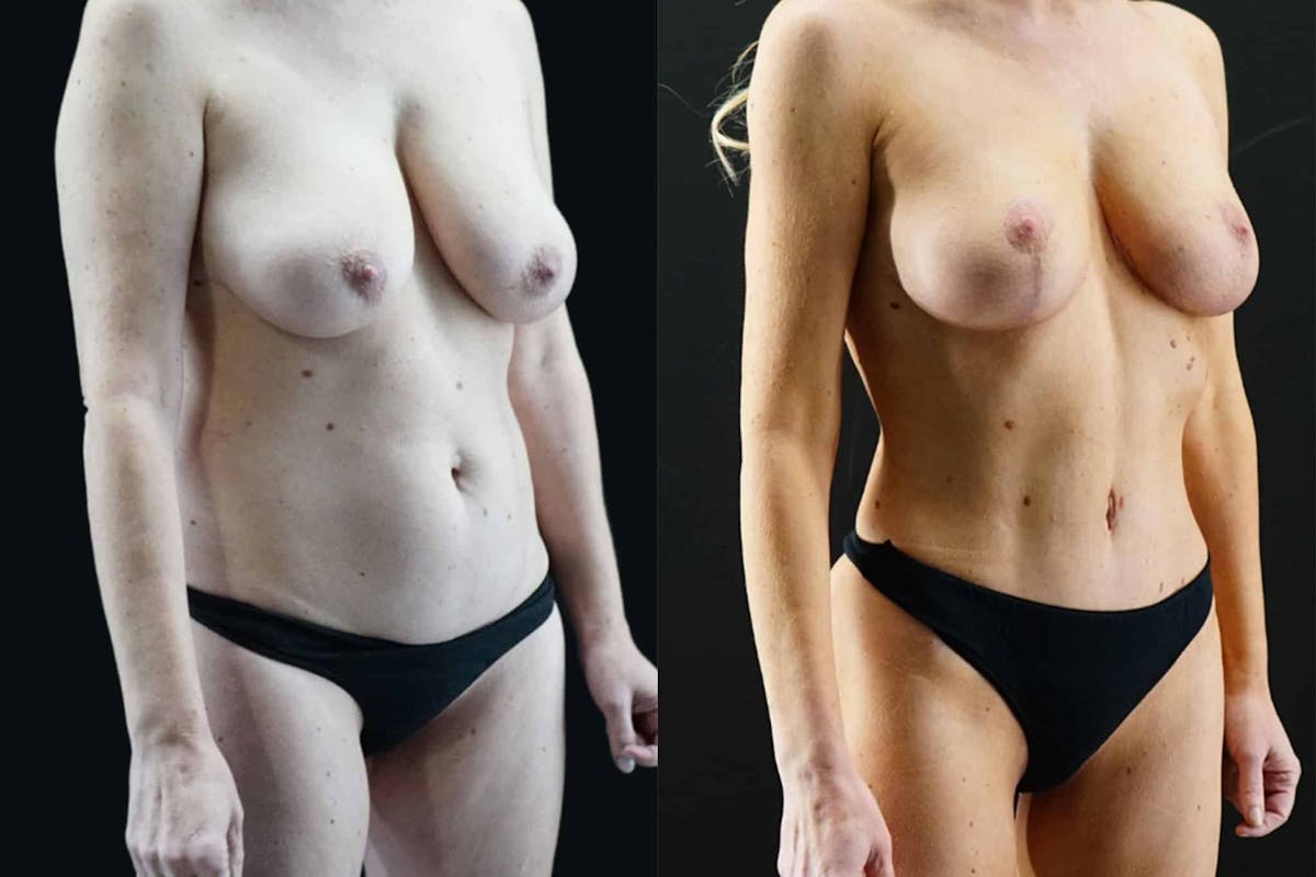 Mommy Makeover Before & After Gallery - Patient 317065 - Image 1