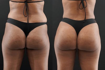 Brazilian Butt Lift Before & After Gallery - Patient 154638 - Image 1