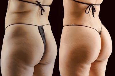 Brazilian Butt Lift Before & After Gallery - Patient 447943 - Image 1