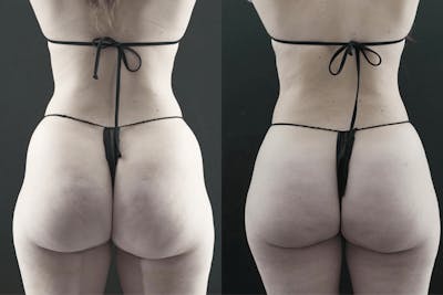 Brazilian Butt Lift Before & After Gallery - Patient 246329 - Image 1