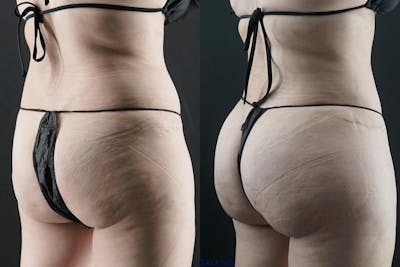 Brazilian Butt Lift Before & After Gallery - Patient 310097 - Image 1