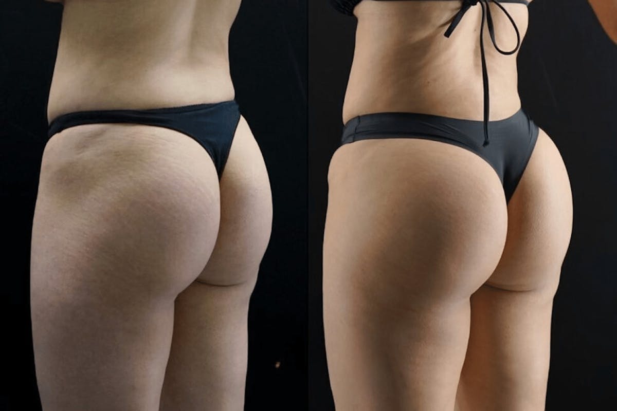 Brazilian Butt Lift Before & After Gallery - Patient 248647 - Image 1