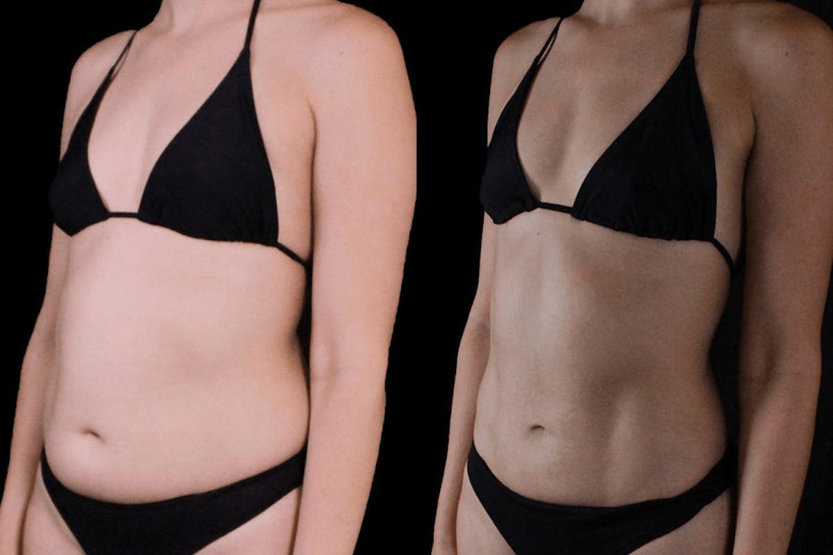 VASER/Hi-Definition Liposuction Before & After Gallery - Patient 342969 - Image 1