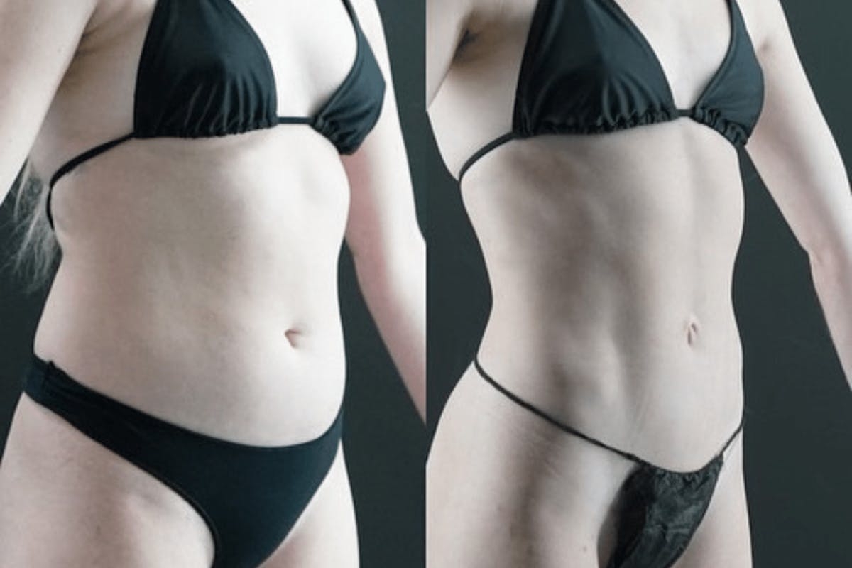 VASER/Hi-Definition Liposuction Before & After Gallery - Patient 255800 - Image 1