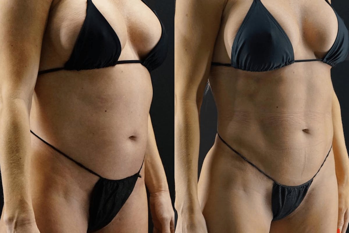 VASER/Hi-Definition Liposuction Before & After Gallery - Patient 648807 - Image 1