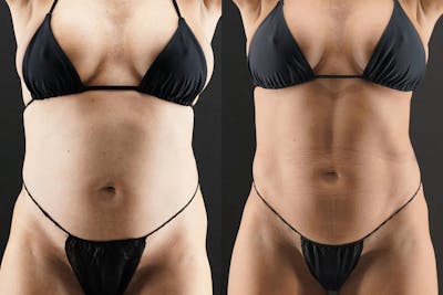 VASER/Hi-Definition Liposuction Before & After Gallery - Patient 602048 - Image 1