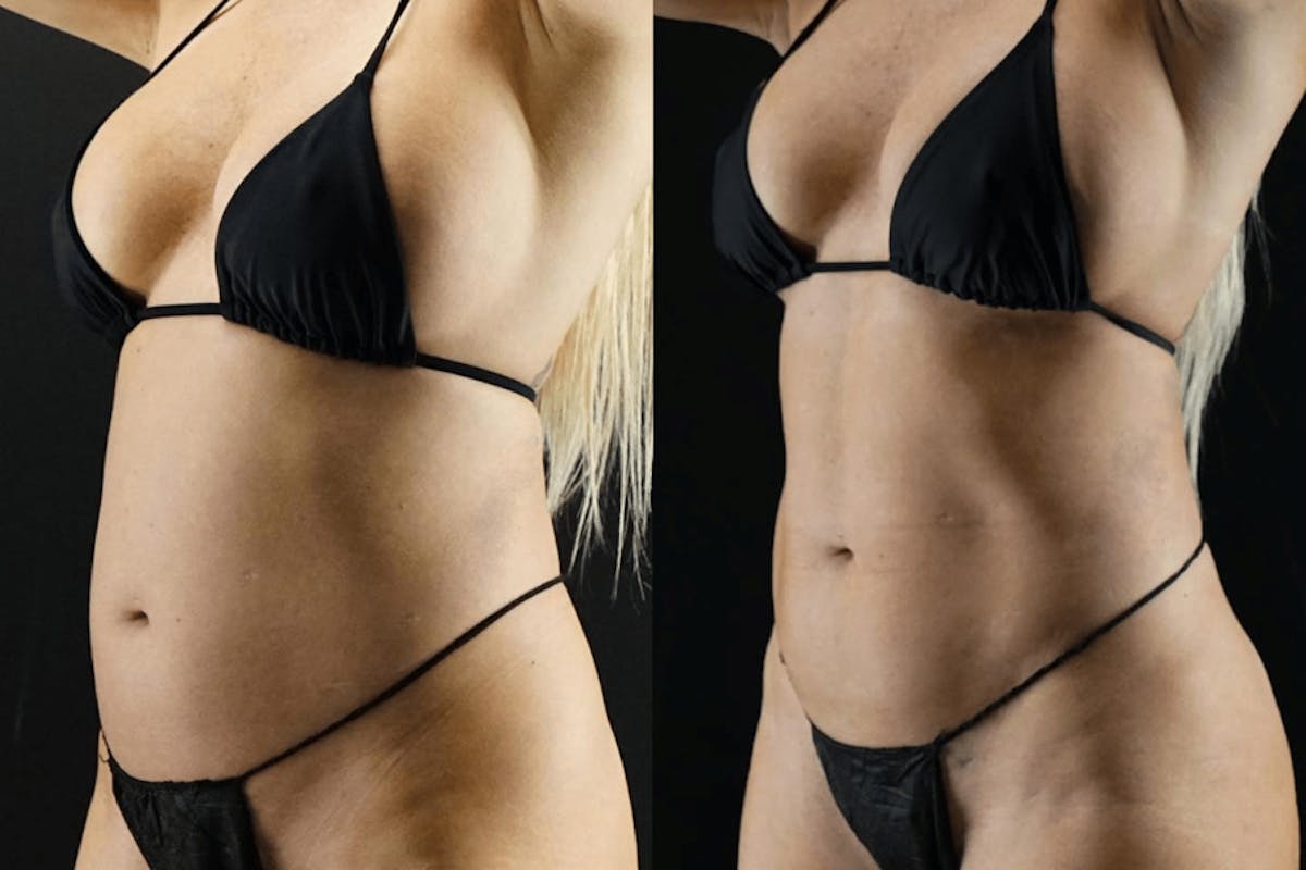 VASER/Hi-Definition Liposuction Before & After Gallery - Patient 247203 - Image 1