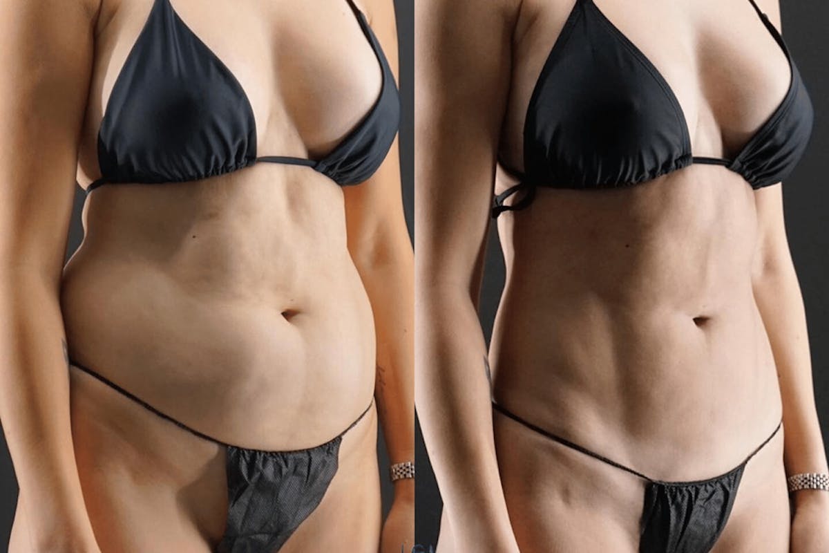 VASER/Hi-Definition Liposuction Before & After Gallery - Patient 286148 - Image 2