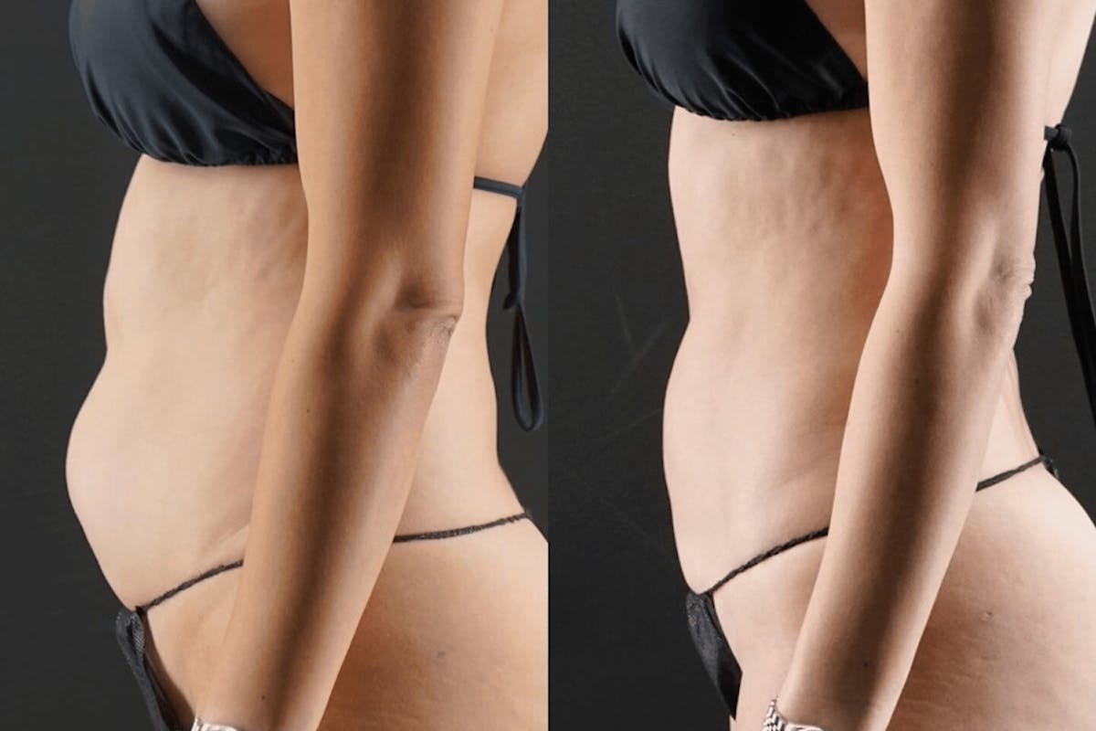 VASER/Hi-Definition Liposuction Before & After Gallery - Patient 286148 - Image 1