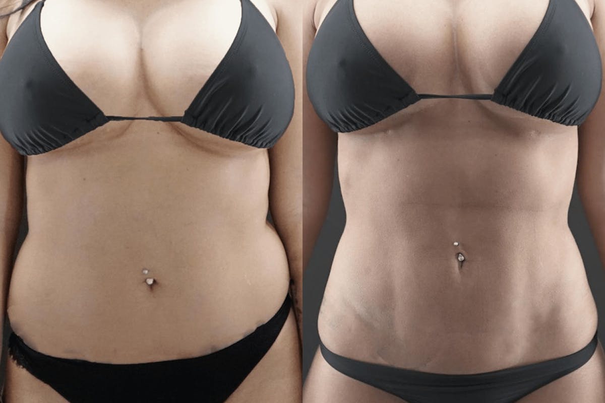 VASER/Hi-Definition Liposuction Before & After Gallery - Patient 136711 - Image 2