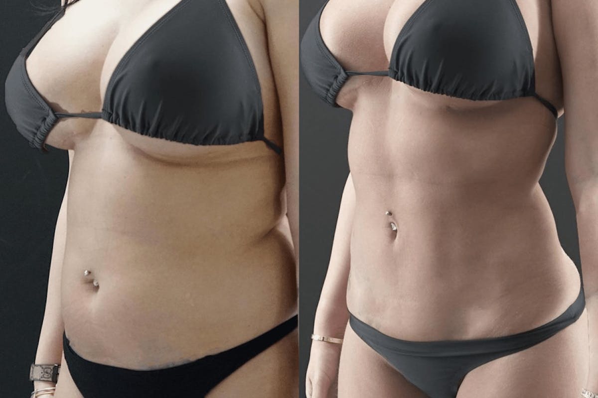 VASER/Hi-Definition Liposuction Before & After Gallery - Patient 136711 - Image 1
