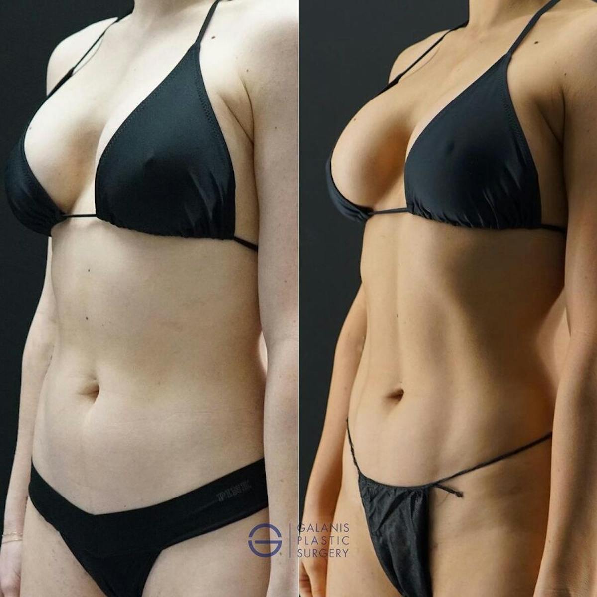 VASER/Hi-Definition Liposuction Before & After Gallery - Patient 137936 - Image 1