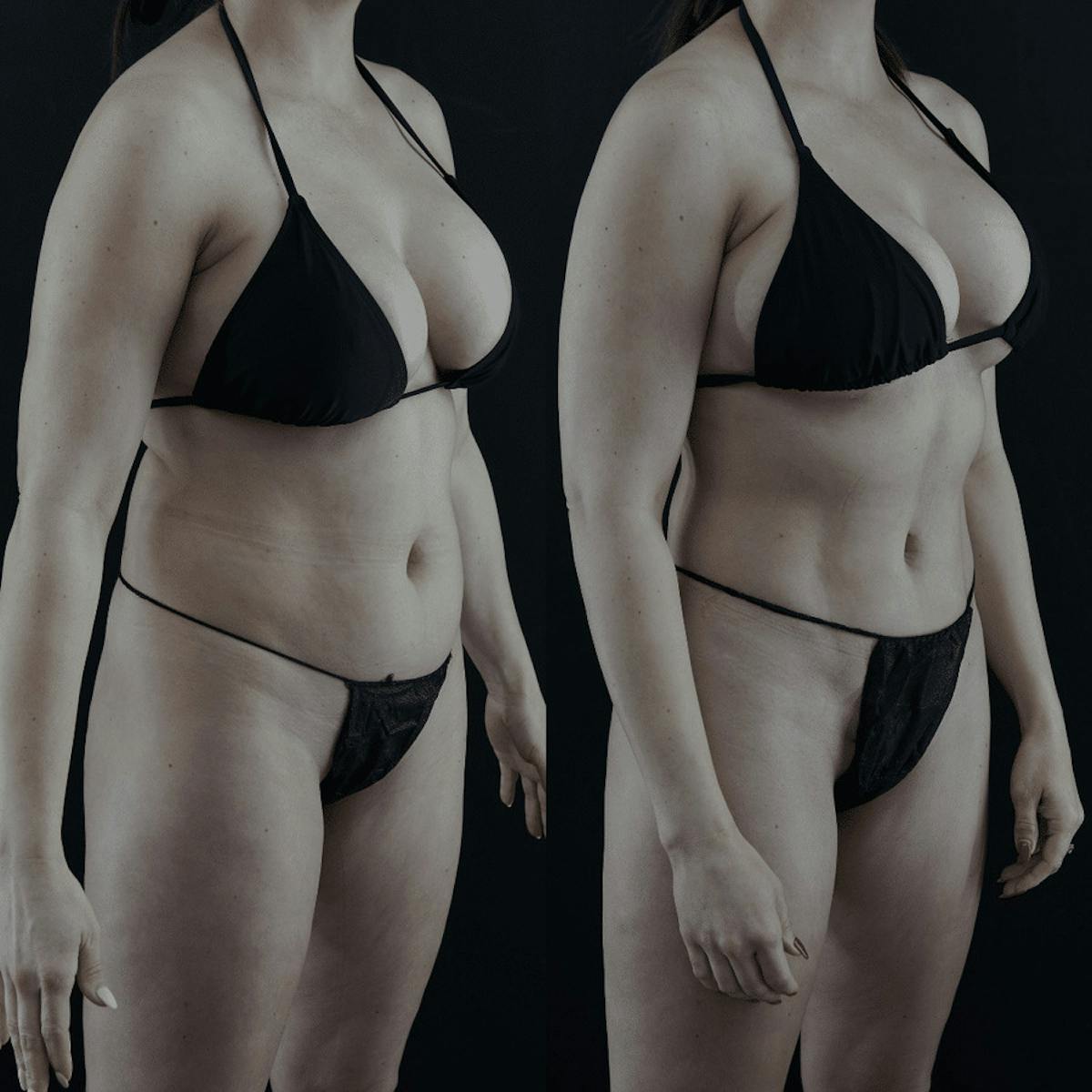 VASER/Hi-Definition Liposuction Before & After Gallery - Patient 263890 - Image 2