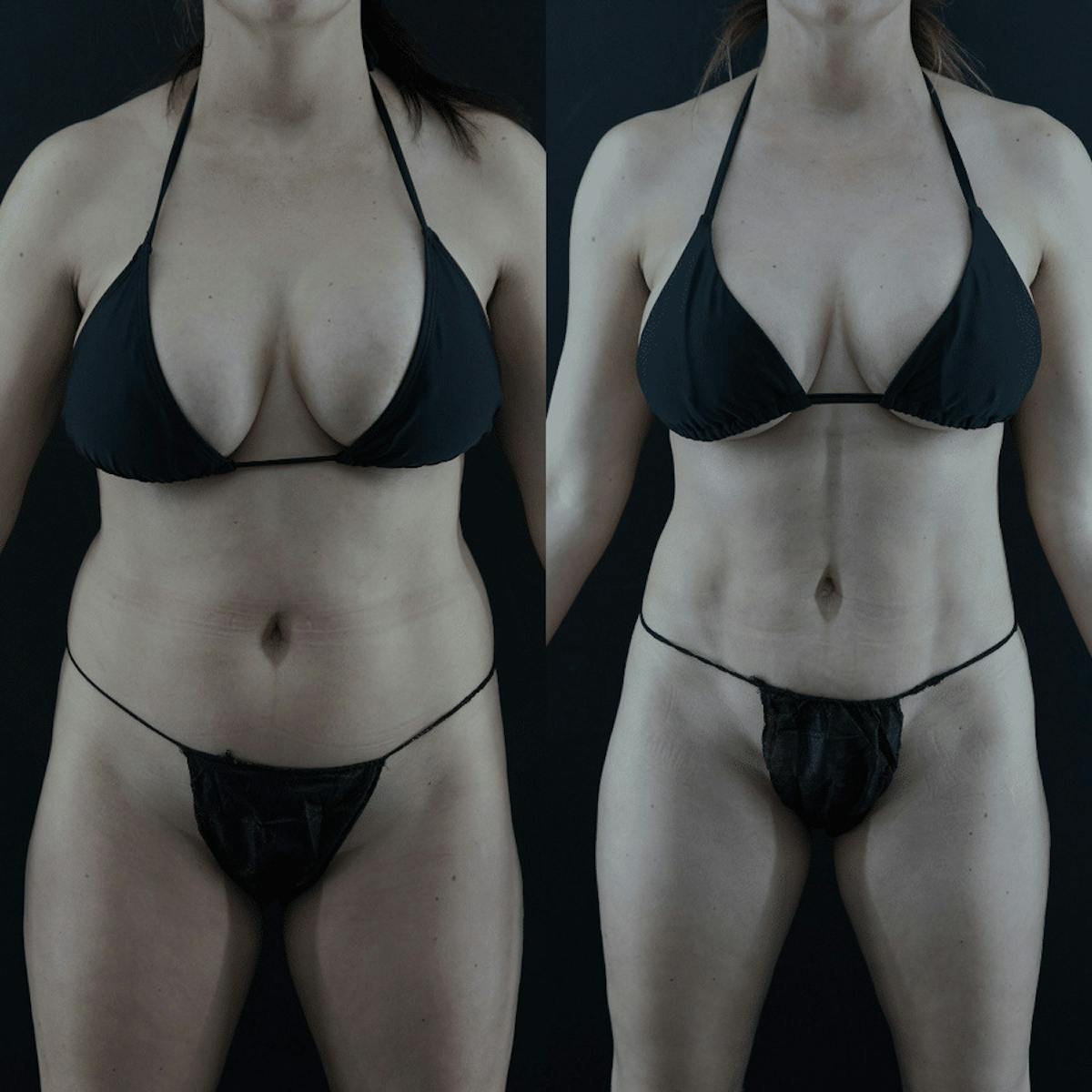 VASER/Hi-Definition Liposuction Before & After Gallery - Patient 263890 - Image 1