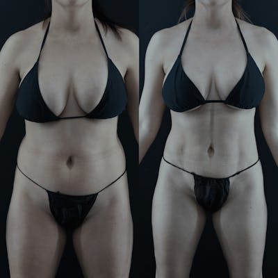 VASER/Hi-Definition Liposuction Before & After Gallery - Patient 263890 - Image 1