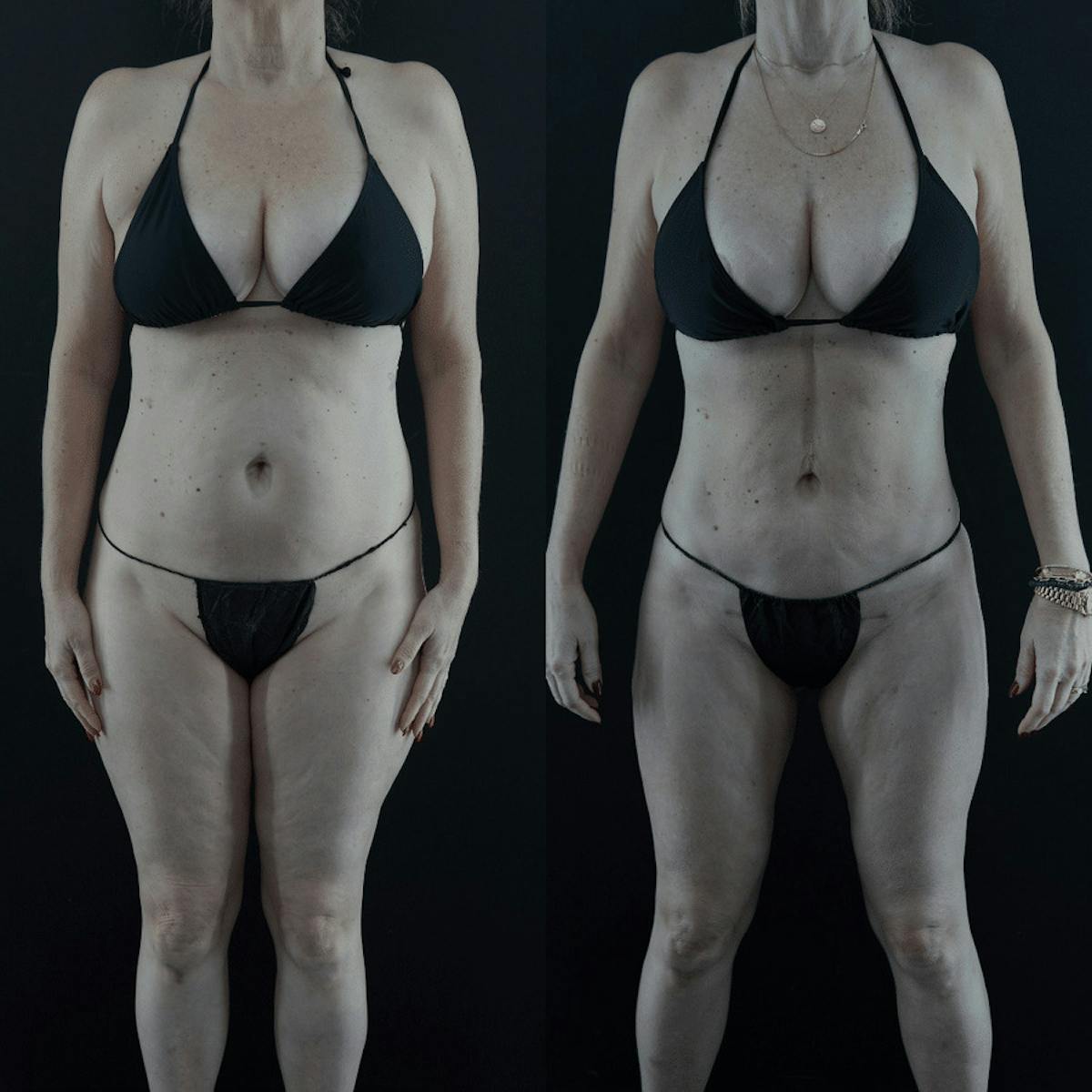 VASER/Hi-Definition Liposuction Before & After Gallery - Patient 335433 - Image 2