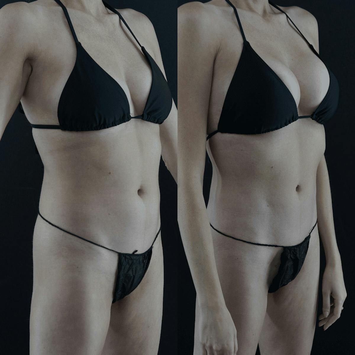VASER/Hi-Definition Liposuction Before & After Gallery - Patient 313527 - Image 4