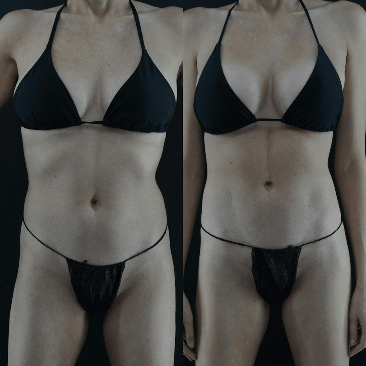 VASER/Hi-Definition Liposuction Before & After Gallery - Patient 313527 - Image 1