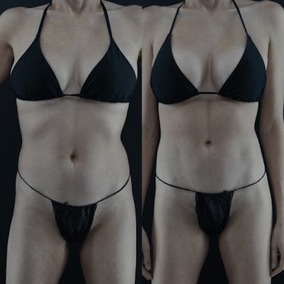 VASER/Hi-Definition Liposuction Before & After Gallery - Patient 313527 - Image 1