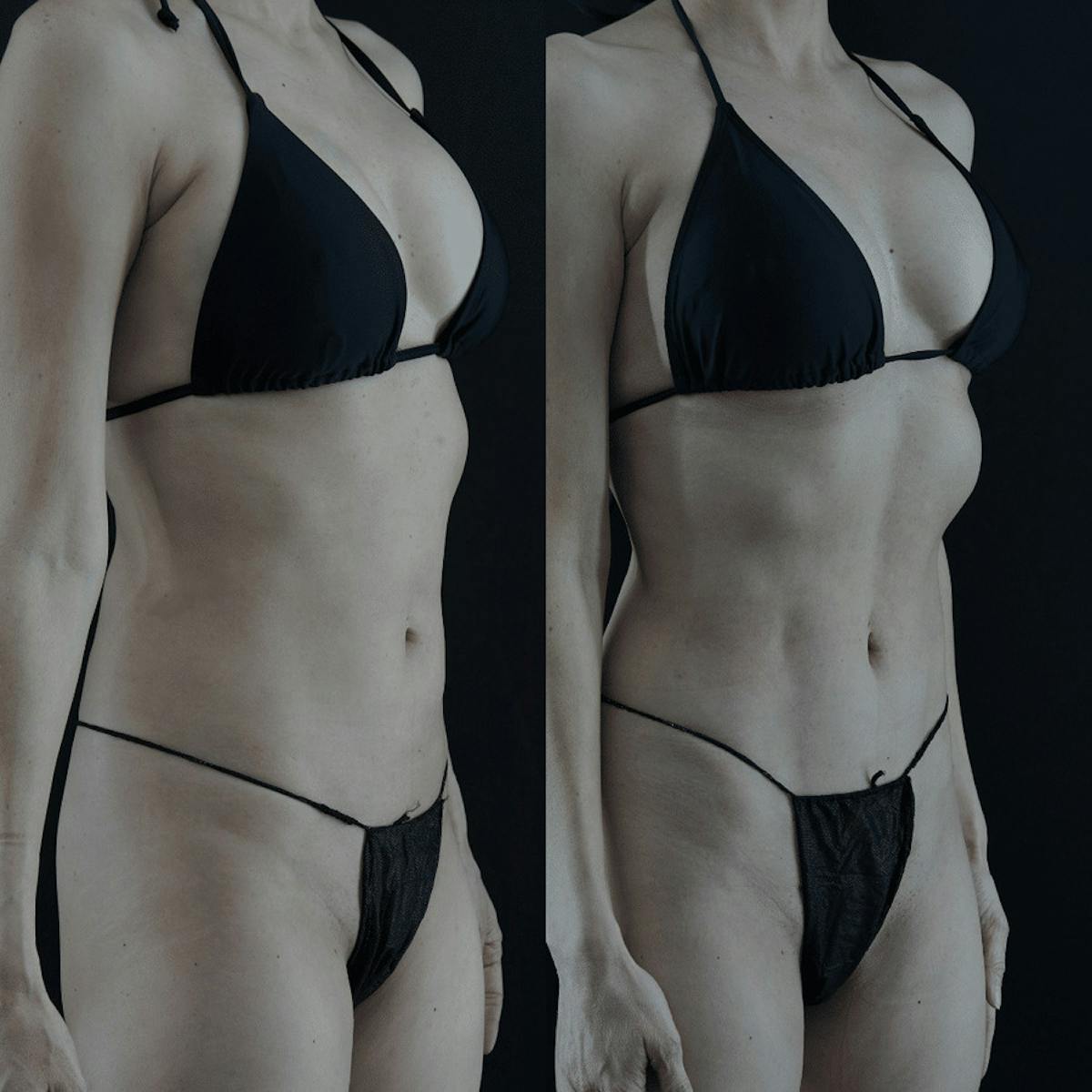 VASER/Hi-Definition Liposuction Before & After Gallery - Patient 217067 - Image 1