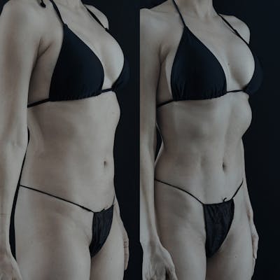 VASER/Hi-Definition Liposuction Before & After Gallery - Patient 217067 - Image 1