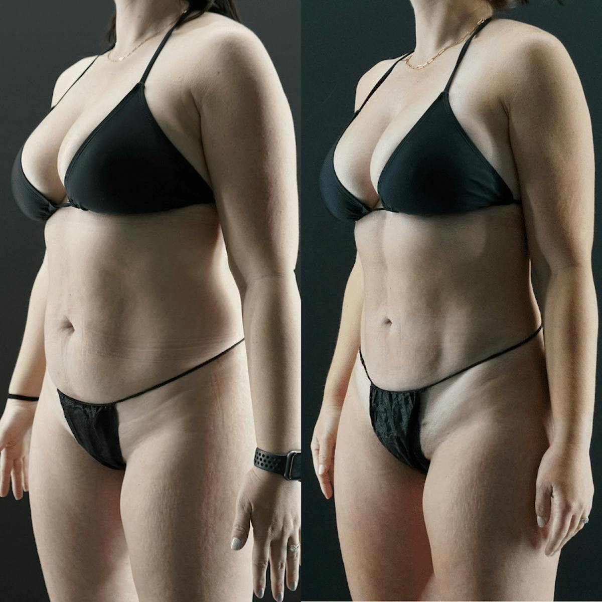 VASER/Hi-Definition Liposuction Before & After Gallery - Patient 353168 - Image 2