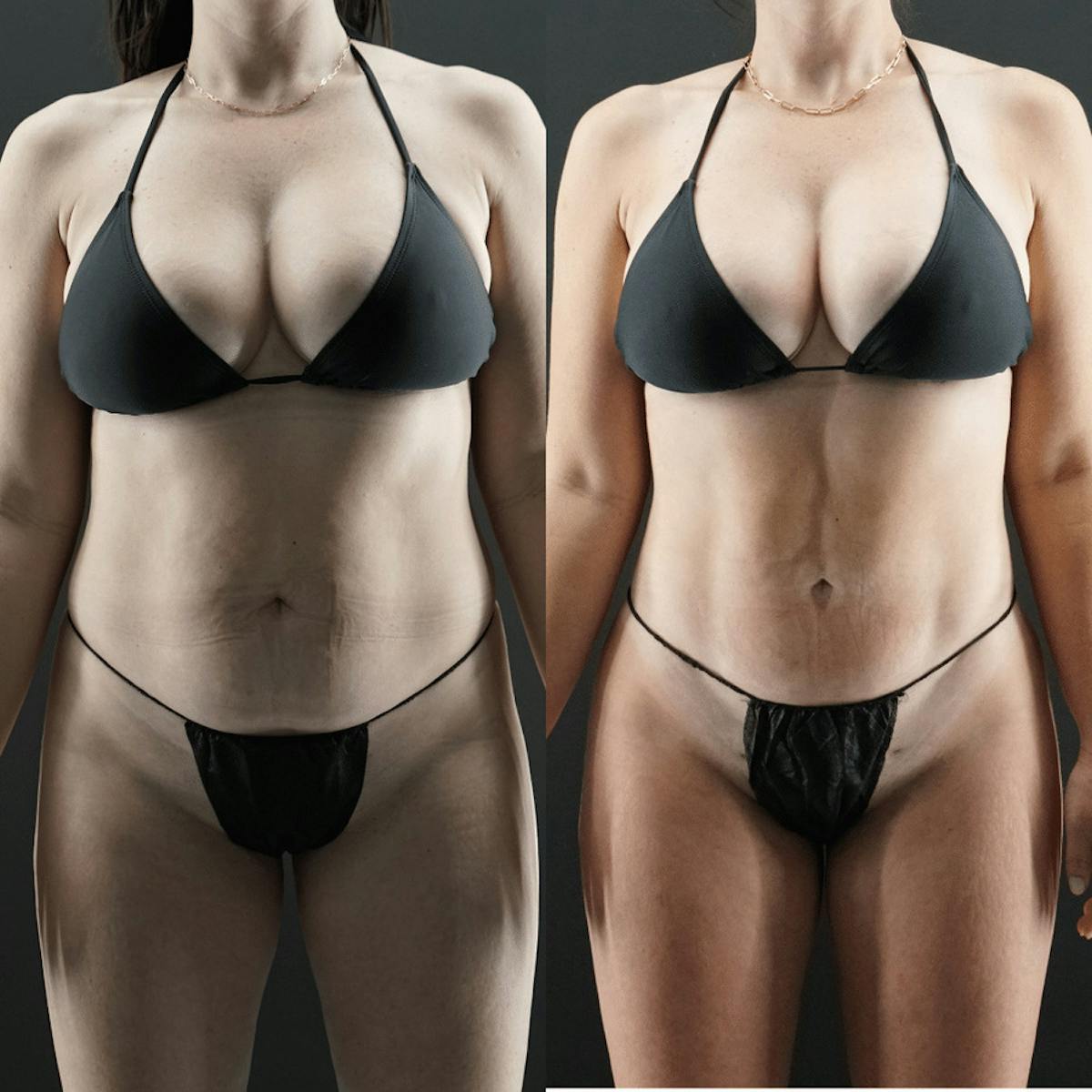 VASER/Hi-Definition Liposuction Before & After Gallery - Patient 353168 - Image 3