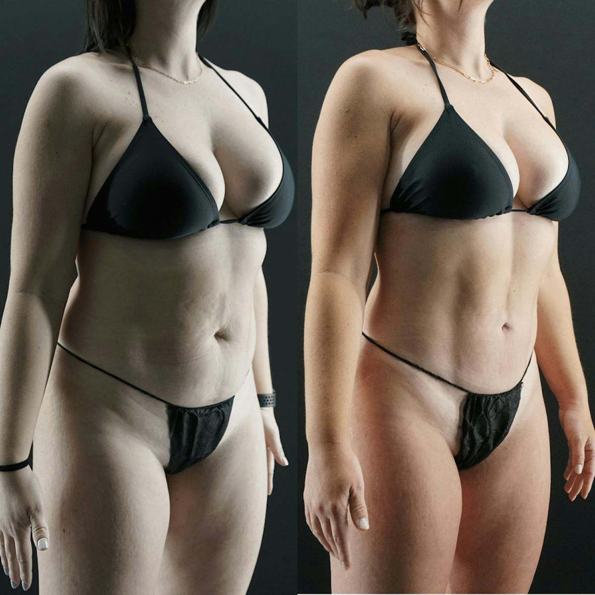 VASER/Hi-Definition Liposuction Before & After Gallery - Patient 353168 - Image 1