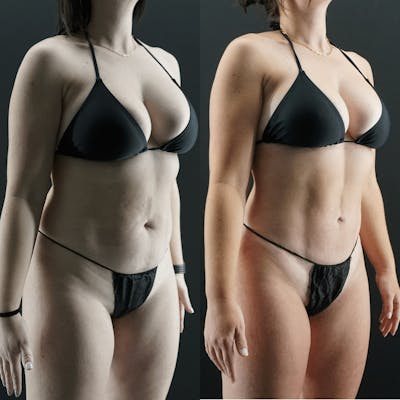 VASER/Hi-Definition Liposuction Before & After Gallery - Patient 353168 - Image 1