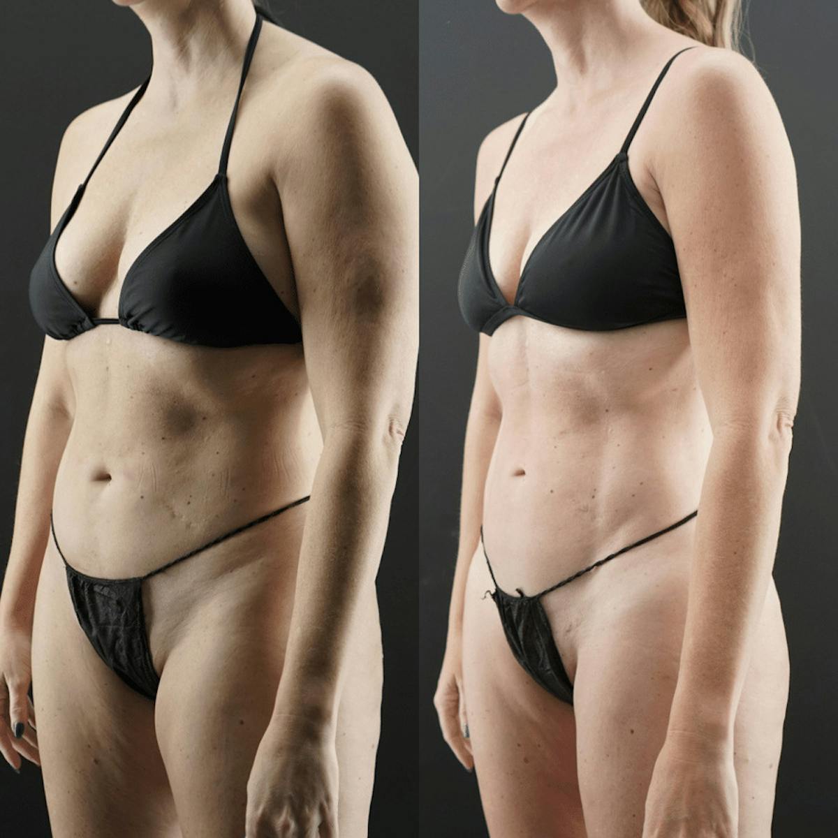 VASER/Hi-Definition Liposuction Before & After Gallery - Patient 139162 - Image 2